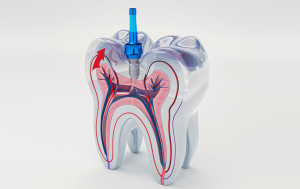 Root Canal Treatment