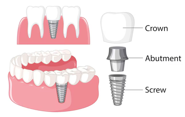 Dental Implant